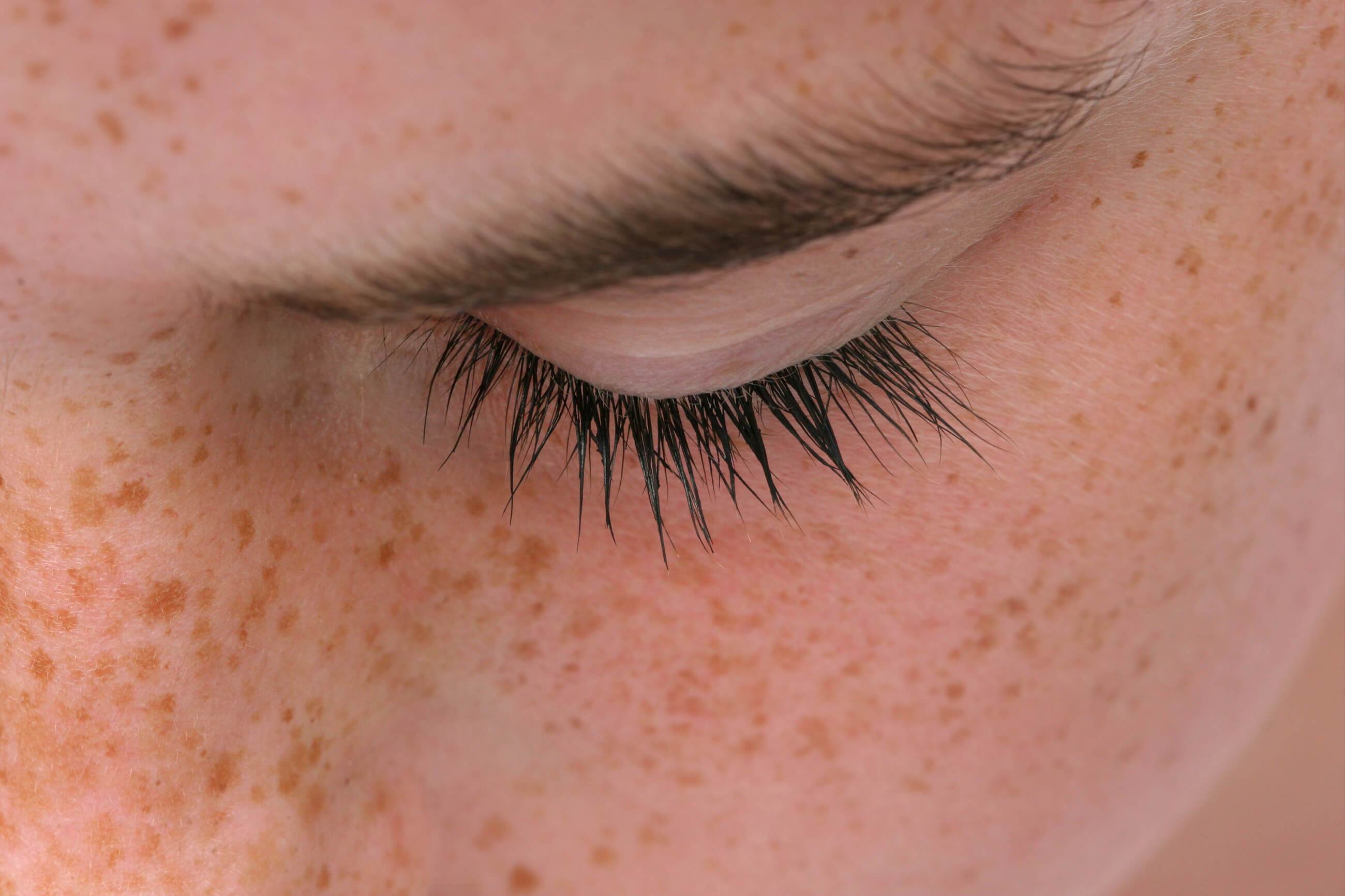 darkspots_face